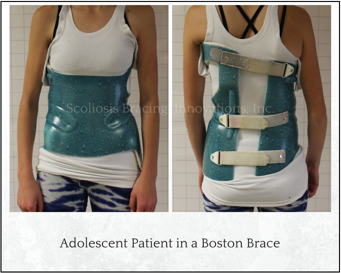 Boston Brace RC (Rigo-Cheneau) Scoliosis Brace - Bio Dynamic