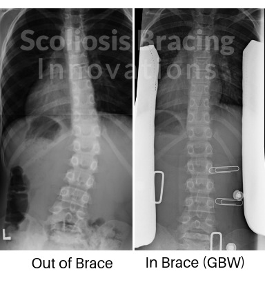 spinal correction