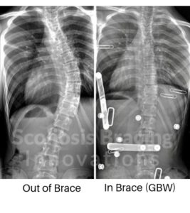scoliosis correction in-brace with GBW