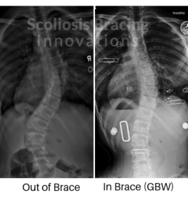 scoliosis correction in-brace GBW