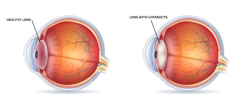 cataracts-illustration