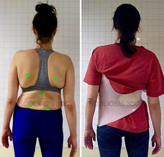 example of adult scoliosis bracing