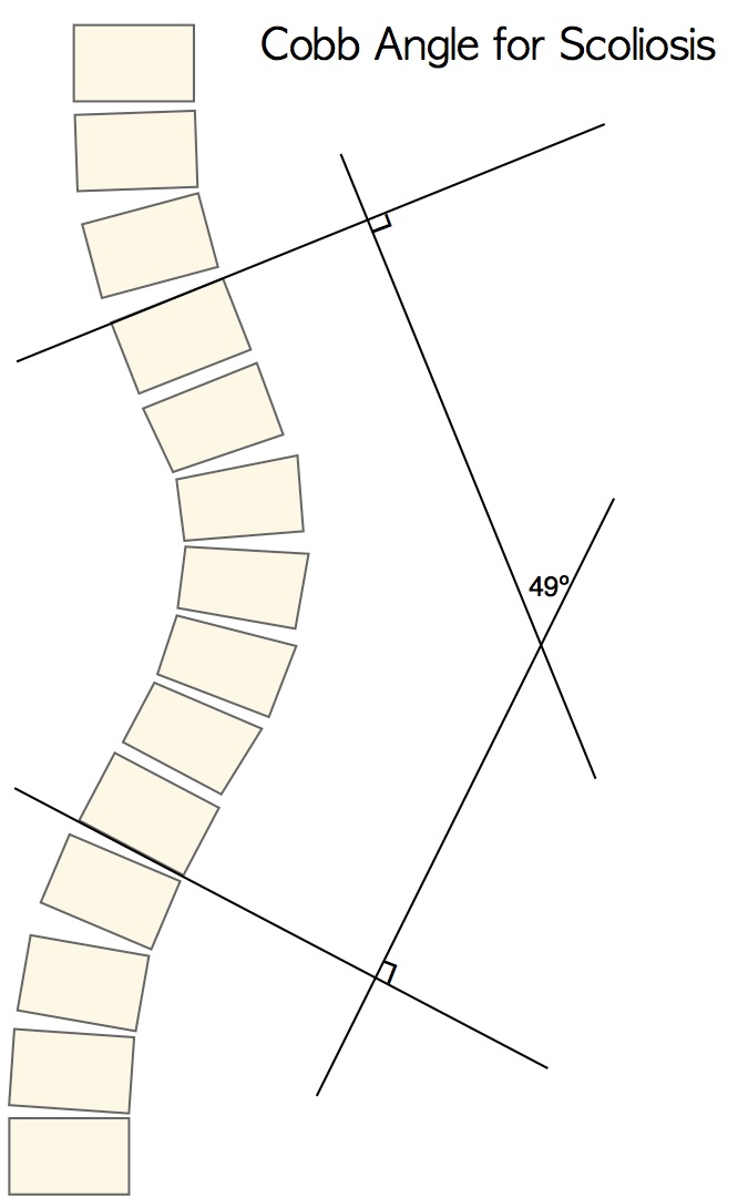 graphic showing the cobb method of measuring scoliosis