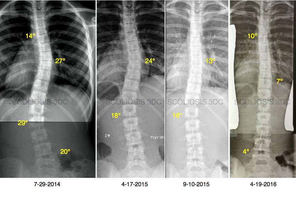 correct scoliosis without surgery