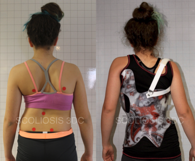 scoliosis brace to avoid scoliosis surgery