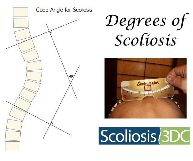 an illustration showing how to measure the scoliosis angle