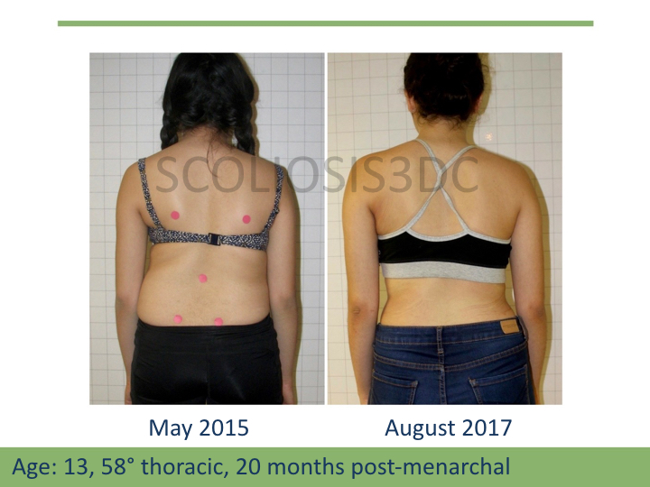 scoliosis results, AOPA