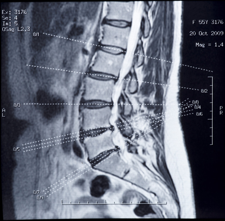 MRI for scoliosis