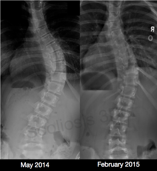scoliosis results