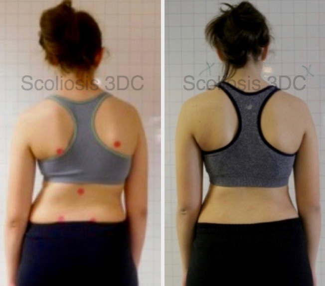 improve scoliosis, scoliosis posture