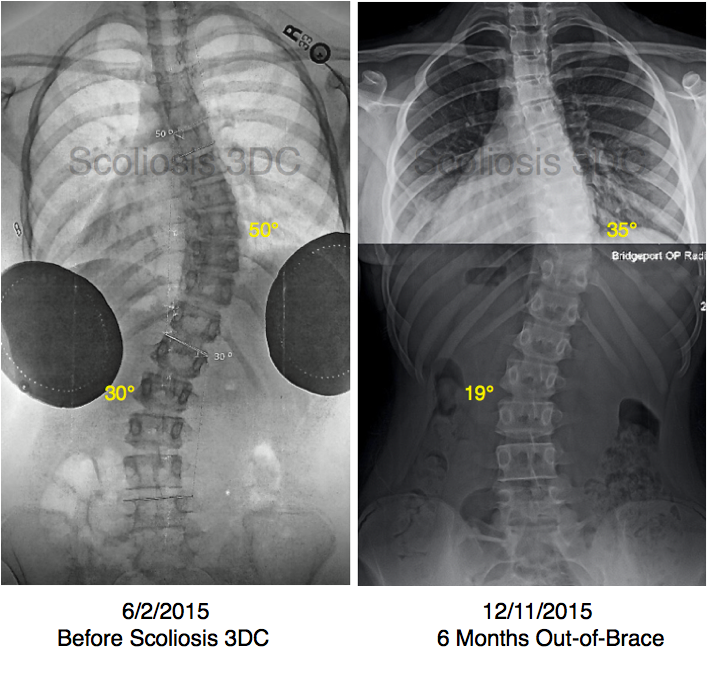 reduce scoliosis without surgery, scoliosis results