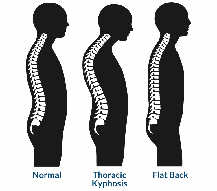 kyphosis, flatback, sagittal spine