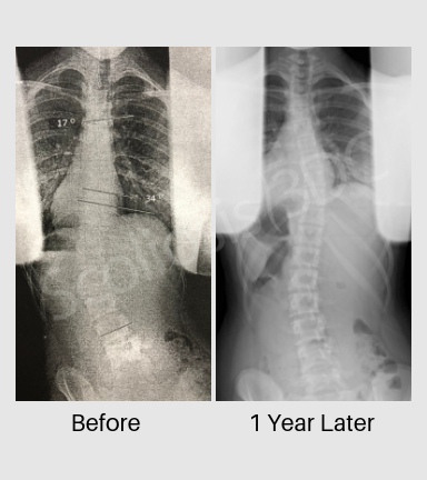 scoliosis reduction