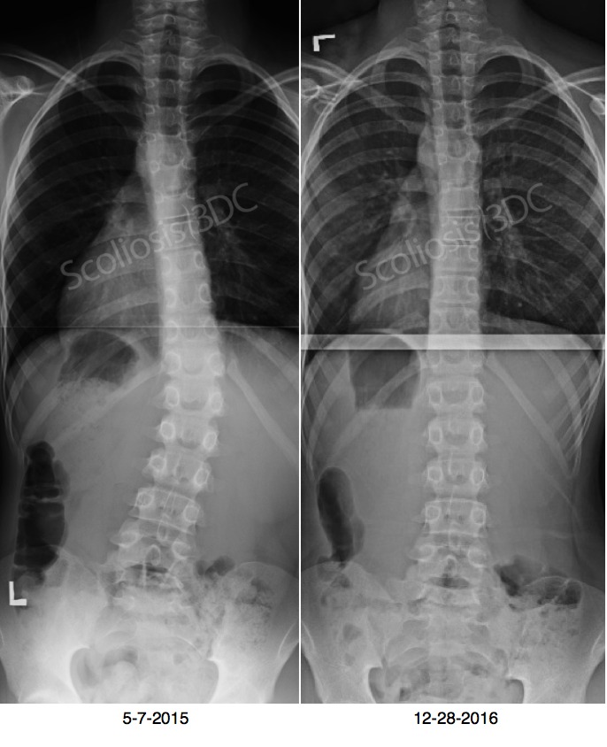 spine with scoliosis now straight