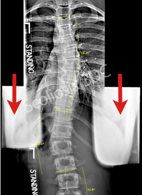 scoliosis and x-rays