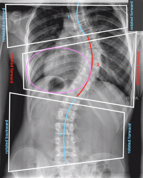 a 3 curve scoliosis x-ray showing body blocks