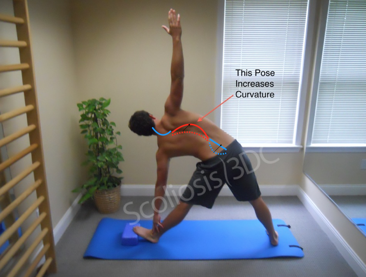 yoga and scoliosis, yoga poses for scoliosis