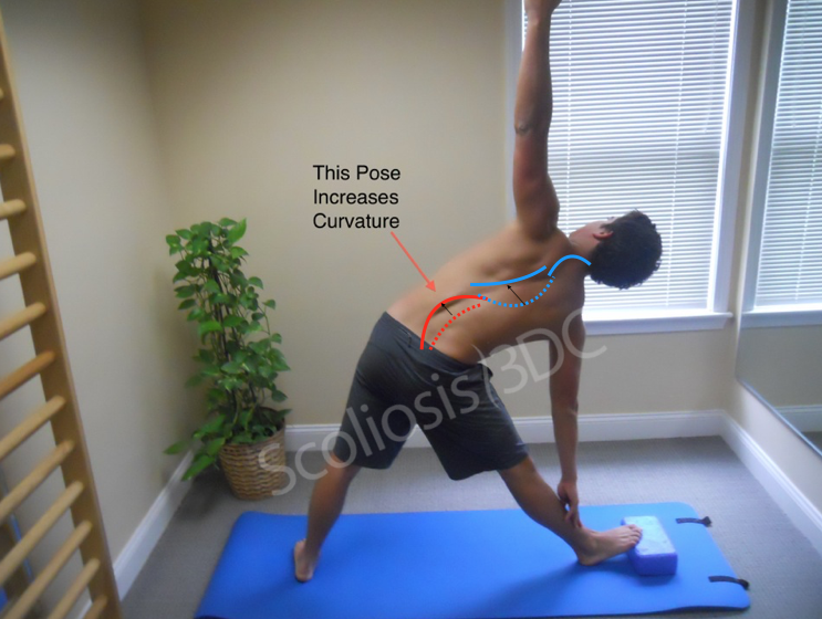 yoga and scoliosis, yoga poses for scoliosis